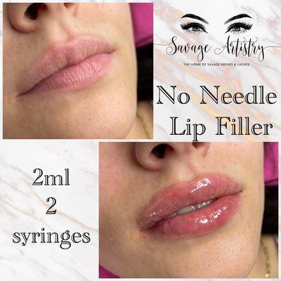 2 syringe No Needle Lip Filler