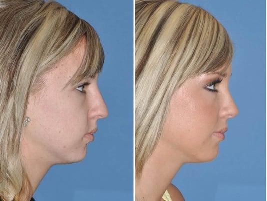 Natural appearing rhinoplasty result, in harmony with the patient's facial features by Dr. Vartanian.