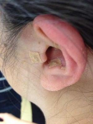 Auricular therapy