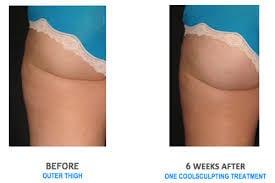 Pre/post Coolsculpting