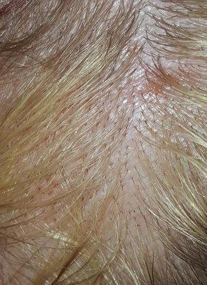 Chemical Burn and scalp irritation