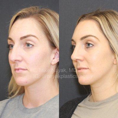 5 Weeks Post Rhinoplasty