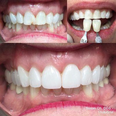 Made 6 Veneers for the top front teeth.  Ultra thin porcelain veneers which means patient never needed numbing shots or temporary veneers.