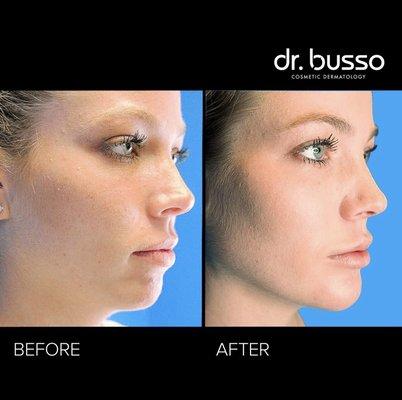 Non-surgical chin augmentation and contouring using Kybella and fillers.