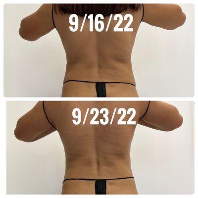 Sculptice + Cavitation = Results