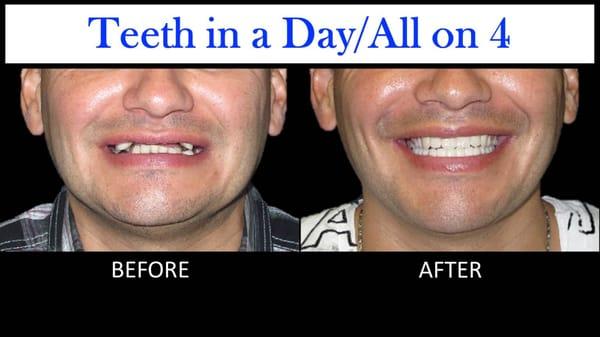 Teeth in a Day / All on 4 Dental Implant Procedure. Actual patient
 
 BOTH upper & lower jaw treated. Same day results. Before and After