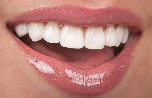 Lumineers, veneers, Invisalign, teeth whitening