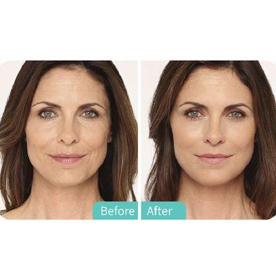 Radiesse Plus dermal filler injection