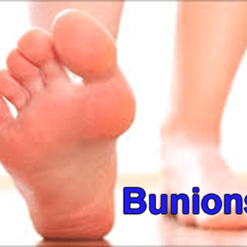 Bunion begone!