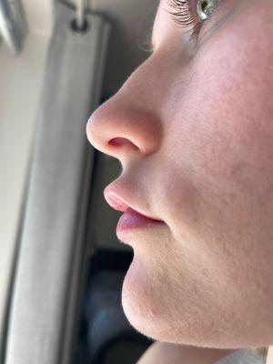 1 month post injection. side profile, duck lips