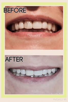 Before - cracked Lumineer veneer. After - Dr. Tripp's bonding work was seamless!!