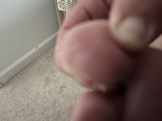 Grated red swollen toe... sorry hard to take a picture my self