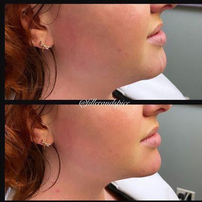 Restylane chin filler before and after.