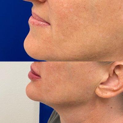 Juvederm volbella