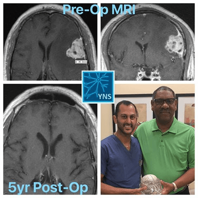 Before and After: 5-years after Brain Surgery, this kind patient remains pain-free, seizure-free, and cured of his brain tumor!