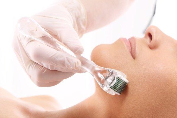 Microneedling