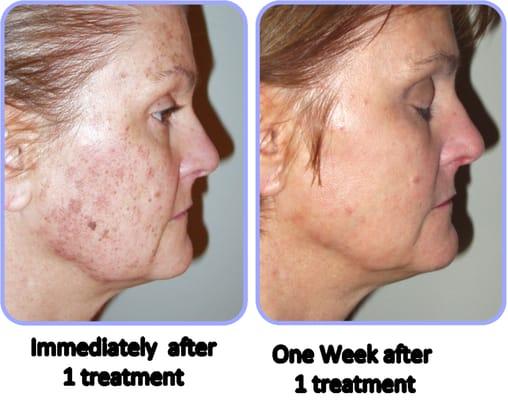 Age Spot, Freckle Removal