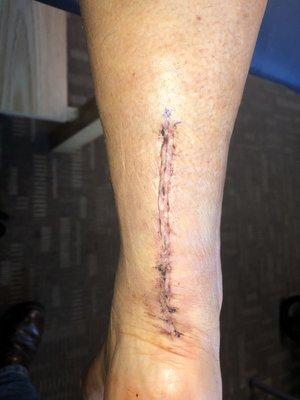 2 weeks post surgery.  Stitches removed.  Great healing!