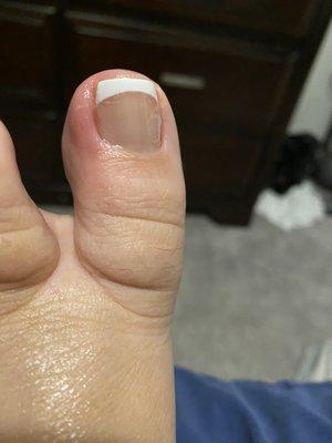 Infected toe