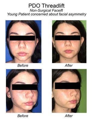 Actual Patient - PDO Facelift