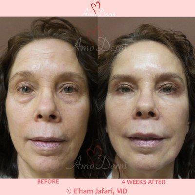 Liquid Facelift with Botox & filler injection in jawlines, under the eyes & cheeks (Belotero, Restylane, Volbella, Voluma, Radiesse)