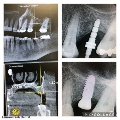 3D treatment plan and perfect execution of an dental implant placement with simultaneous sinus lift.