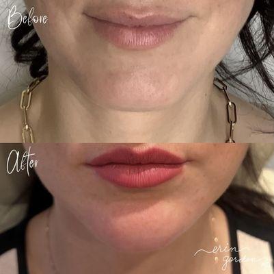 Restylane products placed in the chin