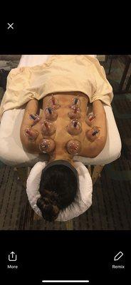 Cupping therapy can help with releasing fascial and muscle tension along with bringing more blood to areas to promote healing.