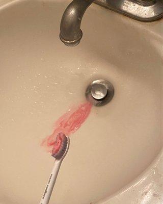 Brushing teeth the SAME night after cleaning was bleeding so much from the pain they gave.