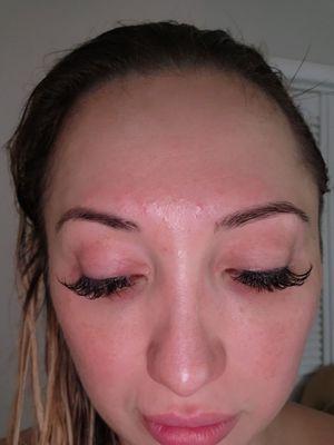 Redness above eyebrows