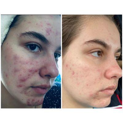 Acne facial, deep pore facial, acne treatments, acne clinic, acne facial, post acne scars treatment  in Tampa, Clearwater, Palm Harbor