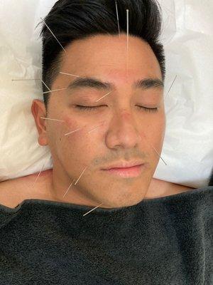 Acupuncture