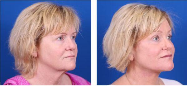 Facelift before and after