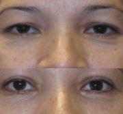 Before and After! 42-Year-Old Female
 Upper & Lower Eyelid Procedures