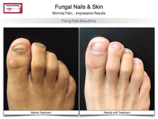 Fungus is not only gross but it's difficult to treat. You must be patient & compliant! Visit www.footfirst.com to learn how we can help.