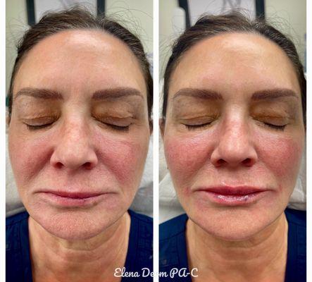 Elena Novak PA-C RHA 2 to treat her oral commissures, marionette lines, and lips. She used Voluma to treat the cheeks.