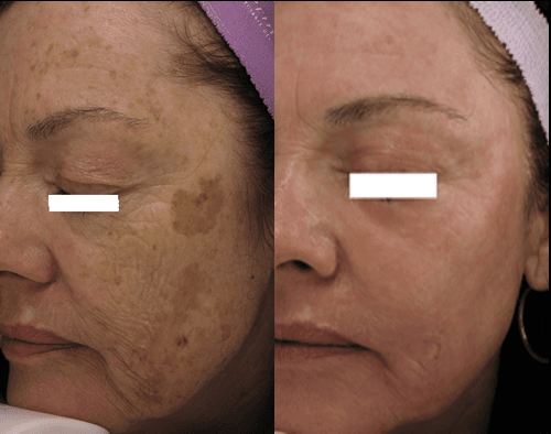 Laser Skin Resurfacing