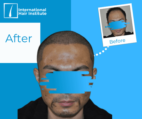 This patients looks great after his hairline, eyebrow, and beard transplant!