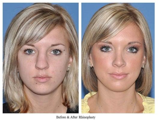 Natural appearing rhinoplasty result, in harmony with the patient's facial features by Dr. Vartanian.