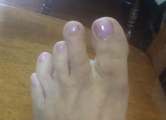 Skin broken on second toe