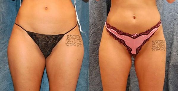 SmartLipo