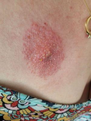 This photo is of contact dermatitis with a few small pustules from having surgical glue (adhesive) after a port removal.