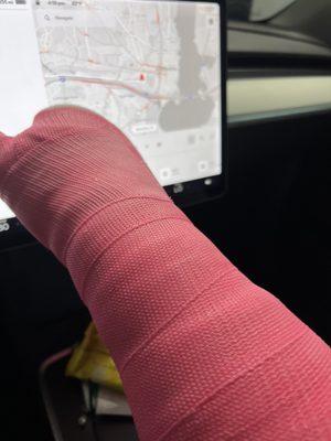 My new pink cast to stabilize the break in my wrist.