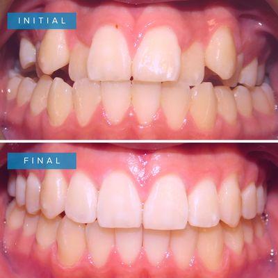 Before and after of our patient.