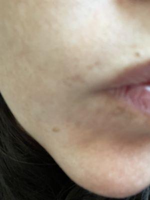 Scars along upper lip