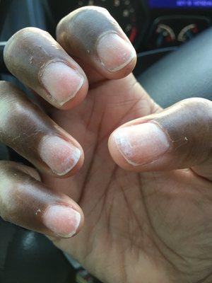 This is what my nails looked like after I had them remove the dip. Nail uneven, cuticles not cleaned up, hang nails, and dead skin.