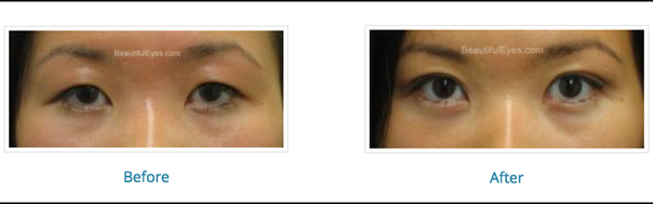 Blepharoplasty - Edison, NJ