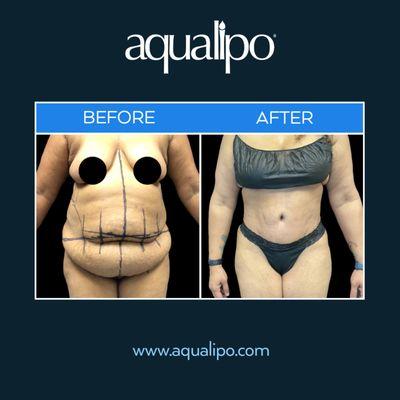 Lipo 360 in Orlando works to remove abdominal fat using a circumferential technique.