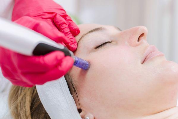 Micro needling at Polished.  We will address fine lines, skin tone, large pores and wrinkles.