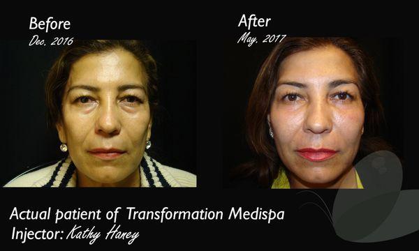 This is the non-surgical facelift using injectible fillers and nueromodulators (such as Botox, Dysport, or Xeomin)